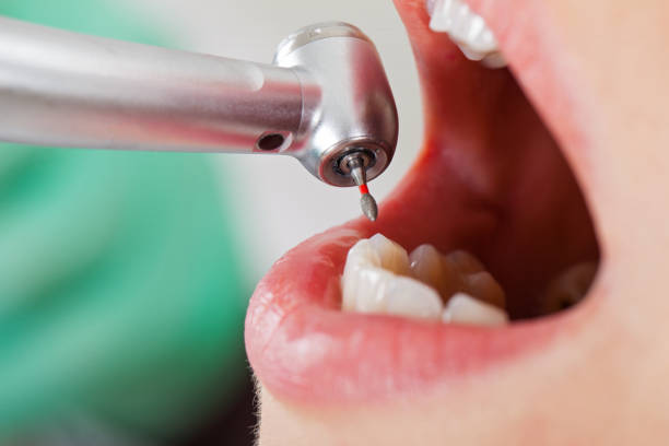 Best Broken or Chipped Tooth Repair in West Hill, OH